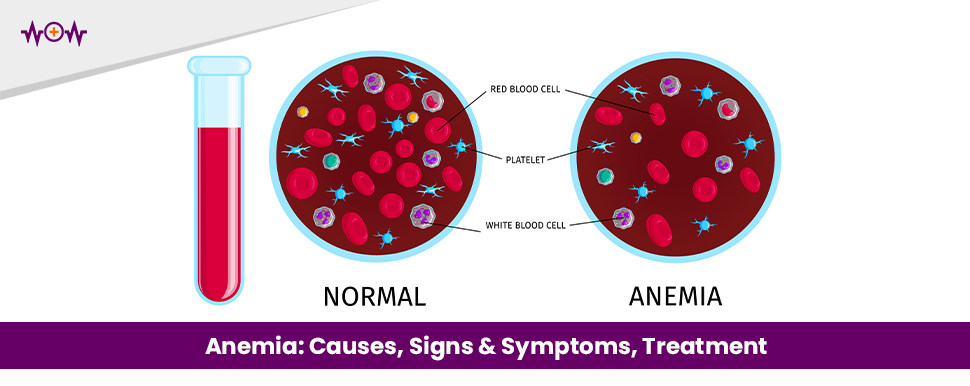 Anemia: Causes, Signs & Symptoms, Treatment