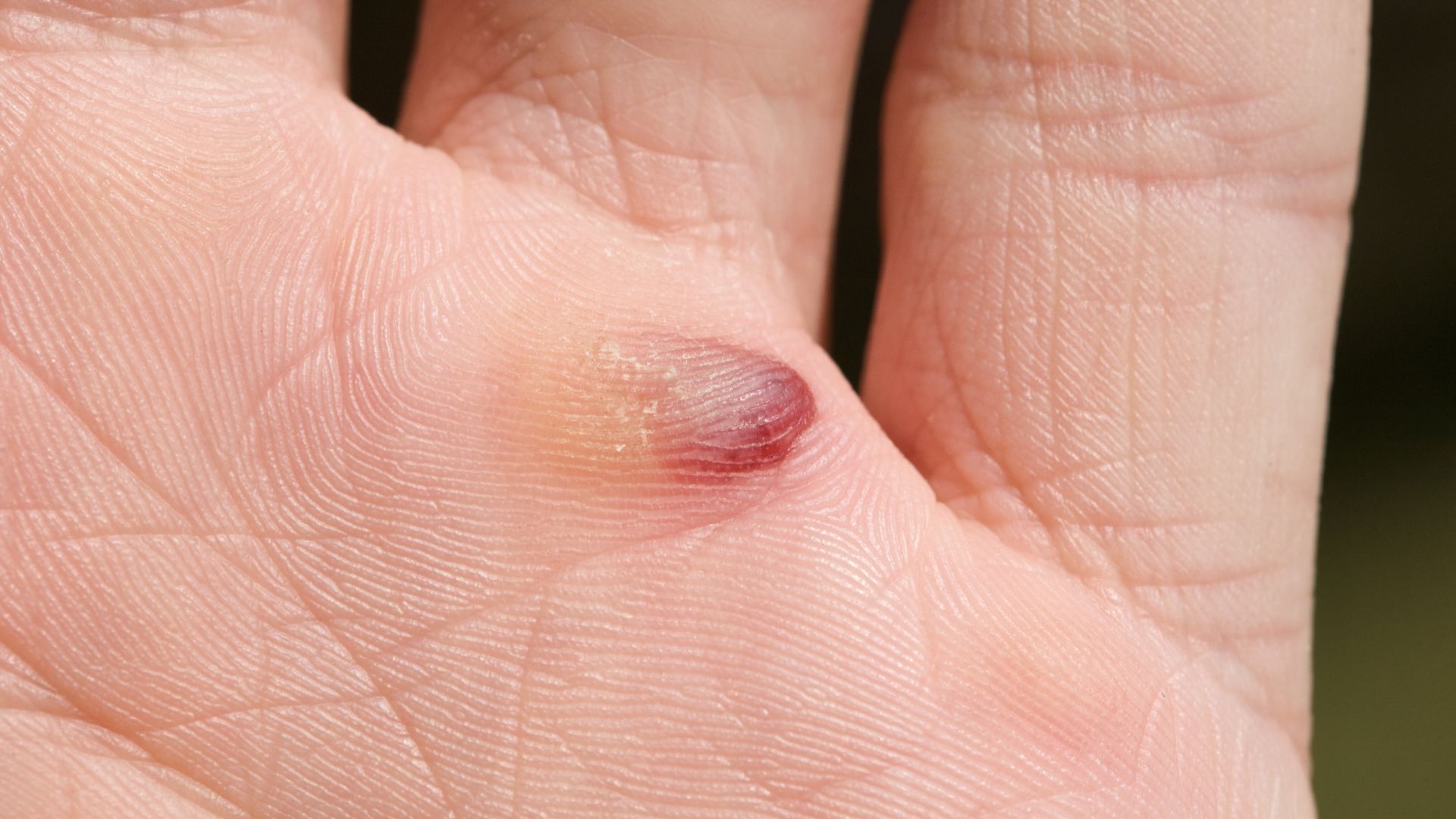 blood blisters