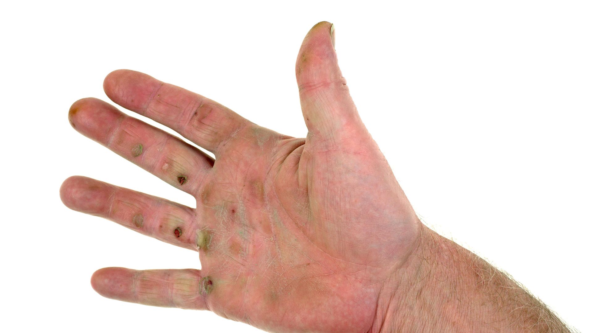 blood blisters