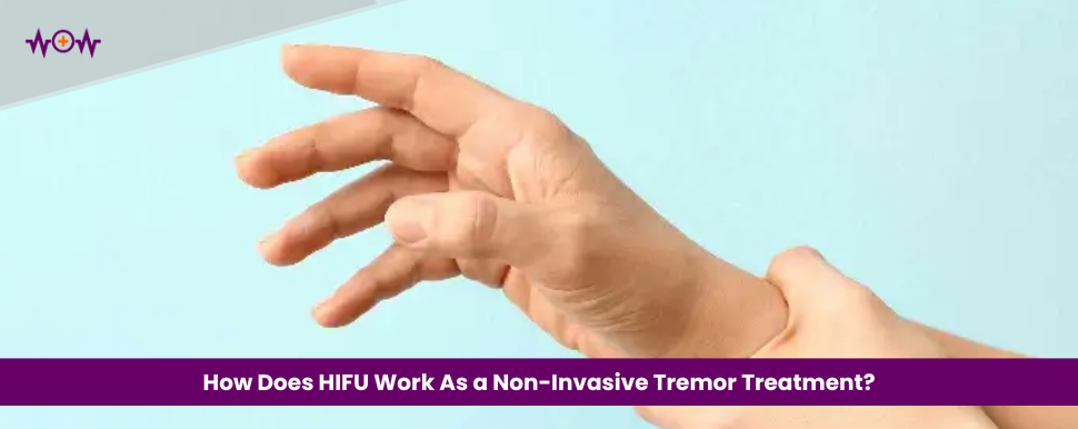 How Does HIFU Work As a Non-Invasive Tremor Treatment?
